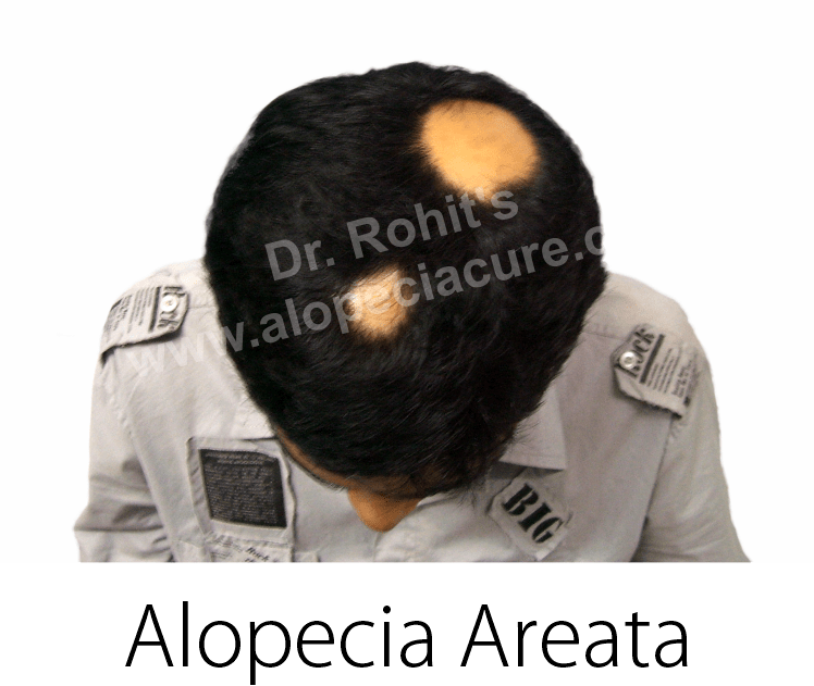 alopecia areata